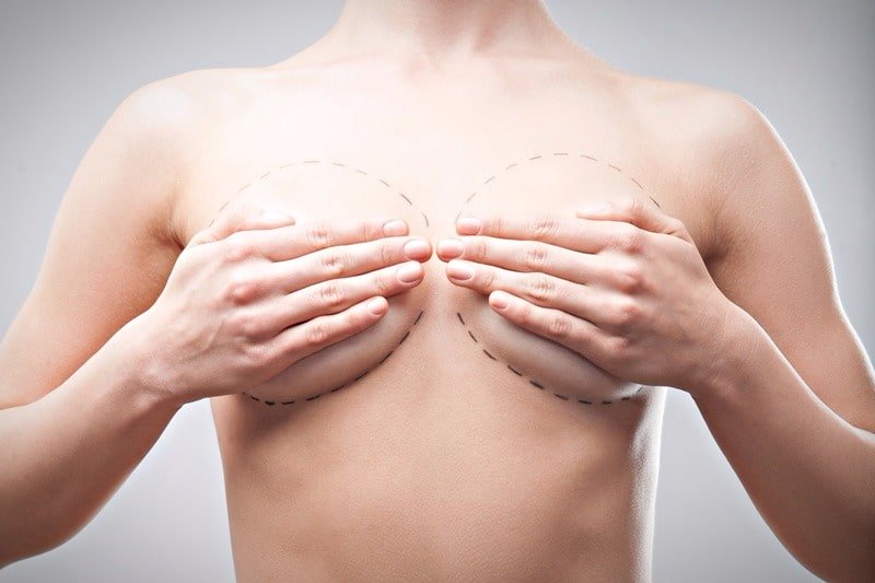 Meme küçültme (breast reduction)
