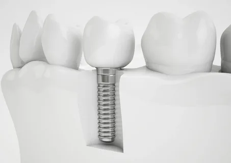 Alanya Diş İmplantı ( Alanya Dental Implant )