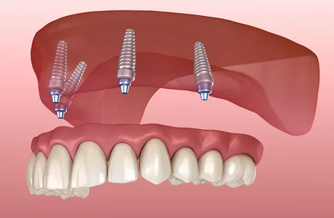 Hepsi Bir Arada Diş İmplantı ( All-in-One Dental Implant )