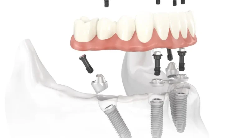 Hepsi Bir Arada Diş İmplantı ( All-in-One Dental Implant )