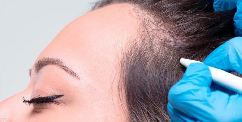 Kadın Saç Ekimi ( Women's Hair Transplant )
