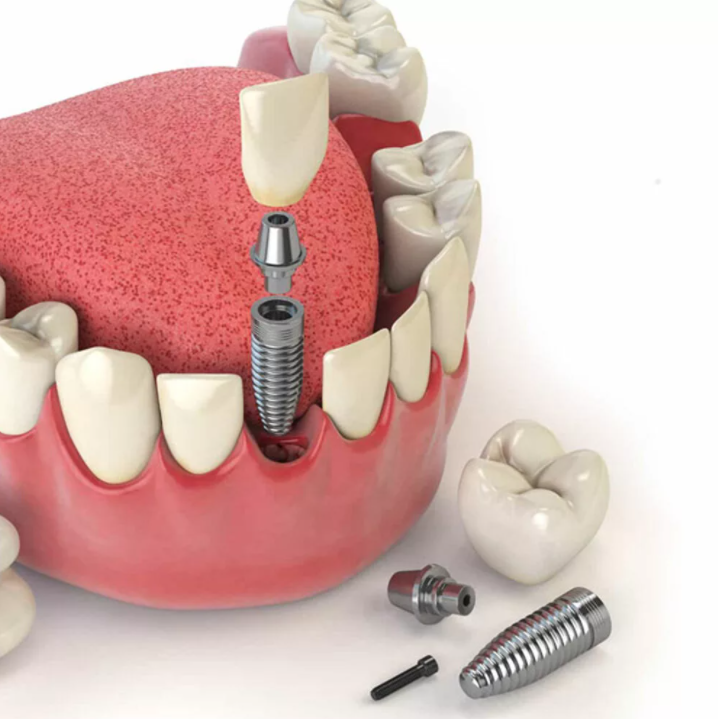 dental implant 6