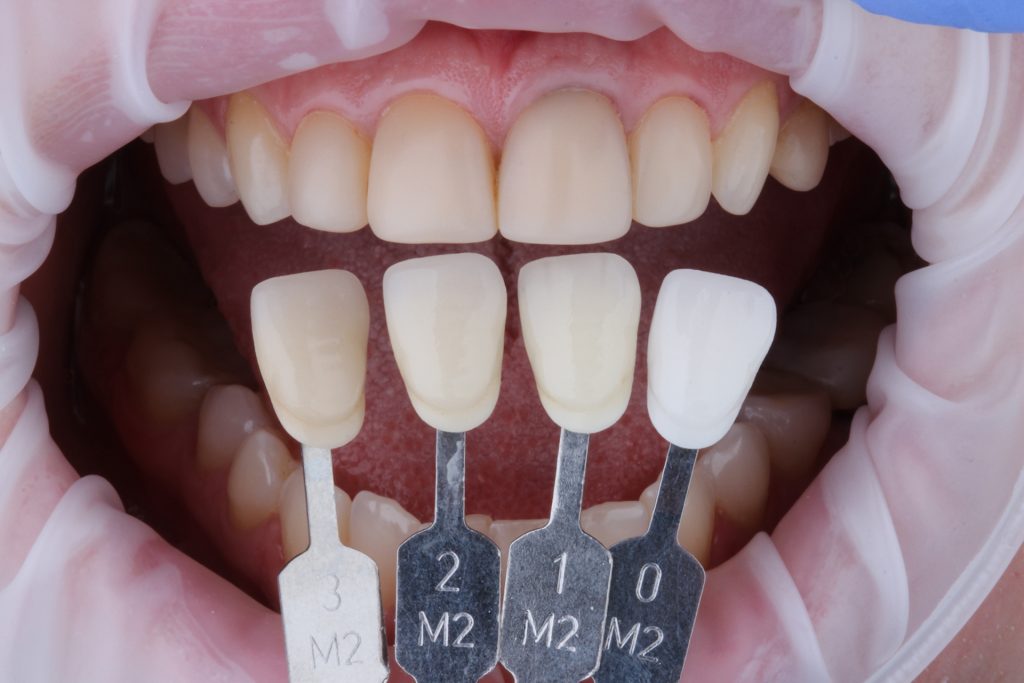 diş kaplama ( dental veneer )