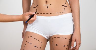 Vaser Liposuction Türkiye Öncesi ve Sonrası