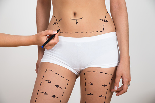 Vaser Liposuction Türkiye Öncesi ve Sonrası